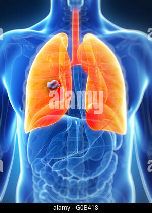 3d rendered illustration of the male lung - cancer Stock Photo