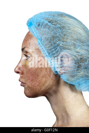 Cosmetology. New skin after a chemical peeling, Stock Photo