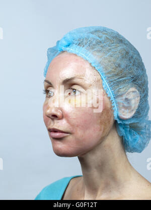 Cosmetology. New skin after a chemical peeling, Stock Photo