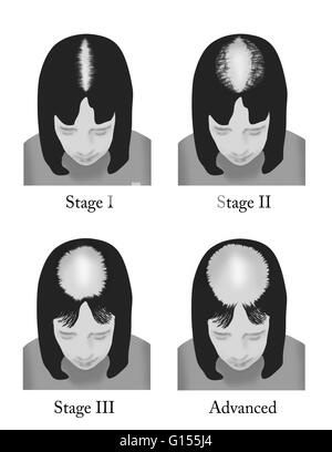 Progressive stages of hair loss in females based on the Ludwig Scale ...