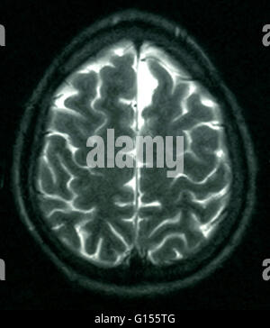 MRI of the brain (axial view) of a 26 year old male. The MRI was taken as a result of head injury in a car accident. Diagnosis from the MRI's is a small arachnoid cyst in the parasagittal anterior left frontal region. All other aspects appear normal. Stock Photo