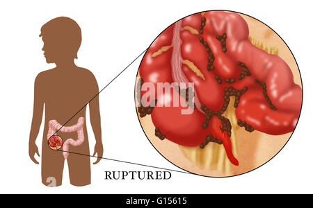 An Illustration of a ruptured appendix caused by untreated appendicitis ...