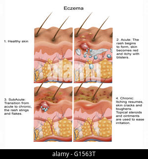 Cross-section illustration of the formation of eczema on the skin in ...