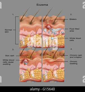 Cross-section illustration of the formation of eczema on the skin in ...