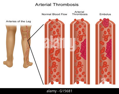 Illustration of a normal leg artery and ones with blood clots (arterial thrombosis and embolus).  An embolus is any detached, traveling intravascular mass carried by circulation, which is capable of clogging arterial capillary beds.  Arterial thrombosis i Stock Photo