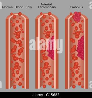 Illustration of a normal artery and ones with blood clots (arterial thrombosis and embolus).  An embolus is any detached, traveling intravascular mass carried by circulation, which is capable of clogging arterial capillary beds.  Arterial thrombosis is th Stock Photo