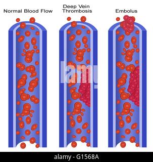 Illustration of a normal vein and ones with deep vein thrombosis (DVT) and embolus.  An embolus is any detached, traveling intravascular mass carried by circulation, which is capable of clogging arterial capillary beds.  Deep vein thrombosis, or deep veno Stock Photo