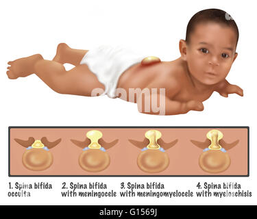 An illustration of a baby with Spina Bifida. Spina bifida is caused ...