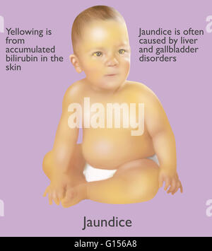 Illustration of an infant with jaundice. Jaundice is often caused by ...