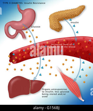 Illustration of insulin and glucose production in Type 2 diabetes Stock ...