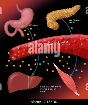 Illustration of insulin and glucose production in Type 2 diabetes Stock ...