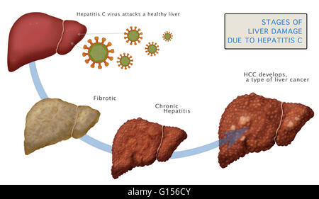 Liver Cirrhosis Stages