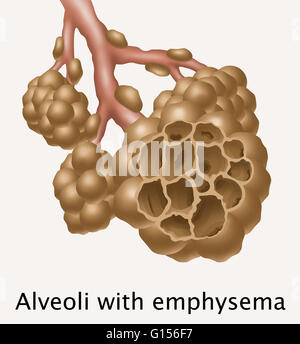 Illustration depicting alveoli with emphysema. The disease is most ...