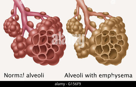 Illustration comparing the appearance of healthy alveoli (top) and ...