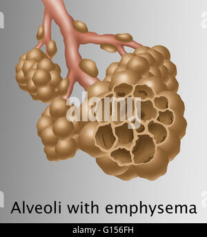 Illustration depicting alveoli with emphysema. The disease is most ...