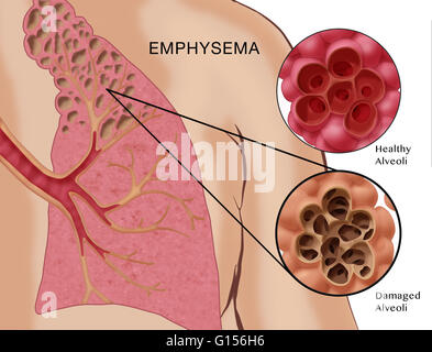 Illustration depicting emphysema, a condition characterized by damage ...