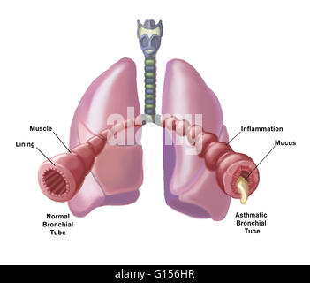 Illustration of the bronchial tubes of the lungs, comparing the appearance of a normal, healthy bronchial tube (left) to one in a person with asthma (right), in which case the bronchial tube becomes inflamed and clogged with mucus. Stock Photo