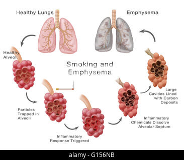 Stages of lung damage of a smoker leading to emphysema. The ...