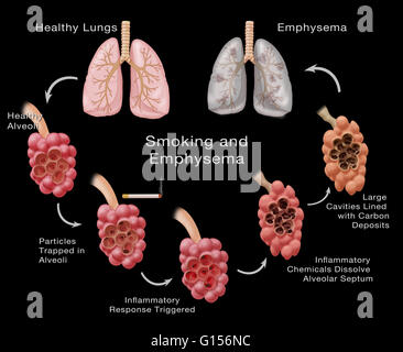 Stages of lung damage of a smoker leading to emphysema. The ...