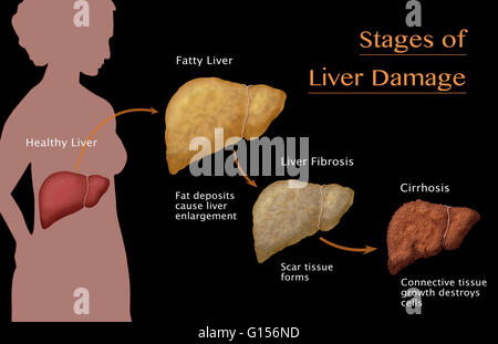 Stages of liver damage due to alcoholism. First alcohol compromises the ...