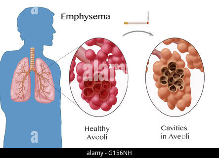 Illustration depicting alveoli with emphysema. The disease is most ...