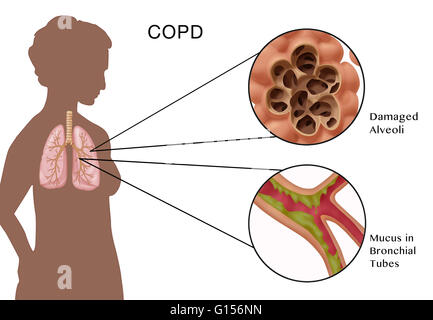 Chronic obstructive pulmonary disease COPD and its treatments. In the ...