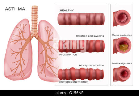 Illustration showing the development of bronchiole constriction ...