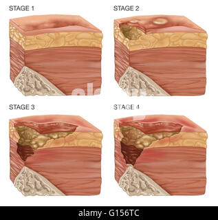 bedsore , pressure sore Stock Photo: 212004394 - Alamy