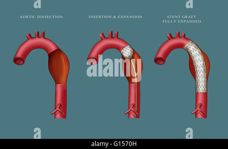 Illustration depicting insertion of an aortic aneurysm stent. Far left ...