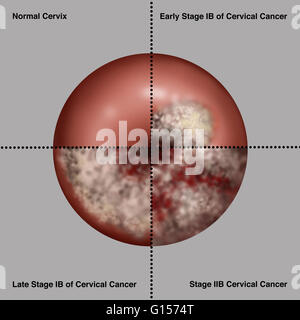 unhealthy cervix