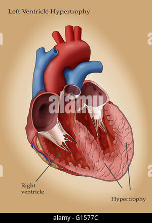 Illustration of the heart showing hypertrophy in the left ventricle. Left ventricle hypertrophy (LHV) can develop in response to factors such as high blood pressure which require the left ventricle to work harder. As the workload increases, the walls of t Stock Photo