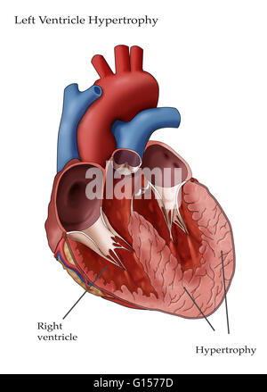 Illustration of the heart showing hypertrophy in the left ventricle. Left ventricle hypertrophy (LHV) can develop in response to factors such as high blood pressure which require the left ventricle to work harder. As the workload increases, the walls of t Stock Photo