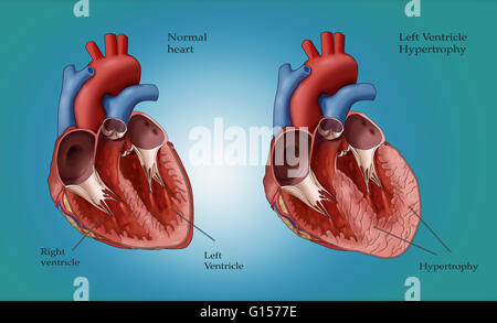 Illustration showing a normal heart at left and a heart with left ventricle hypertrophy at right. Left ventricle hypertrophy (LHV) can develop in response to factors such as high blood pressure which require the left ventricle to work harder. As the workl Stock Photo