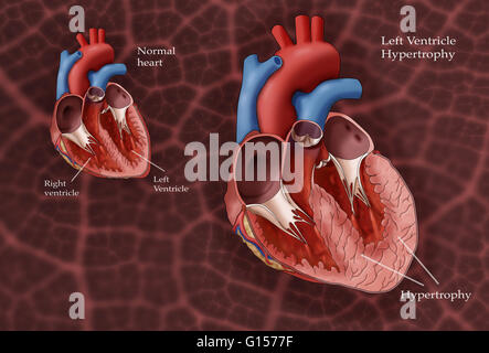 Illustration showing a normal heart at left and a heart with left ventricle hypertrophy at right. Left ventricle hypertrophy (LHV) can develop in response to factors such as high blood pressure which require the left ventricle to work harder. As the workl Stock Photo