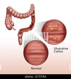 Illustration showing effects of ulcerative colitis on intestinal walls. Ulcerative colitis is an inflammatory bowel disease affecting the inner lining of the large intestine. The disease is characterized by the development of ulcers which begin damaging t Stock Photo