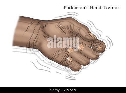 Illustration of a hand tremor, one of the symptoms of Parkinson's ...