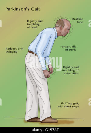 Parkinsons disease infographic Stock Vector Art & Illustration, Vector ...