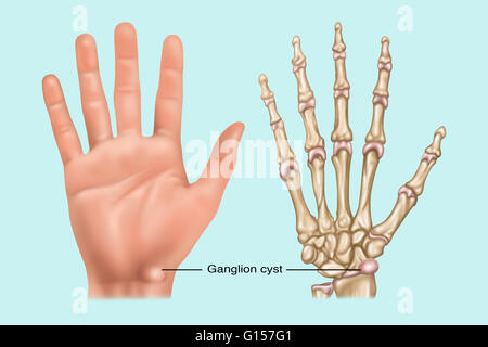 Illustration showing a ganglion cyst (fluid filled sac) in the wrist. Shown both on the skin surface and on the bone. Stock Photo