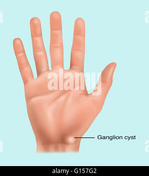 Illustration showing a ganglion cyst (fluid filled sac) in the wrist. Stock Photo