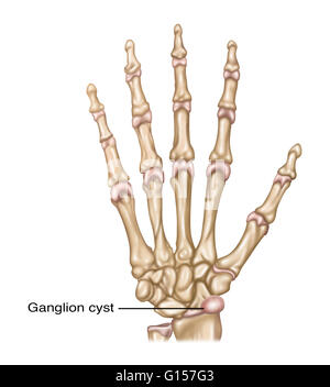 Illustration showing a ganglion cyst (fluid filled sac) in the wrist. Stock Photo