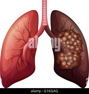 Normal lung and lung cancer Stock Vector Image & Art - Alamy