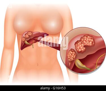 Liver cancer diagram in detail illustration Stock Vector