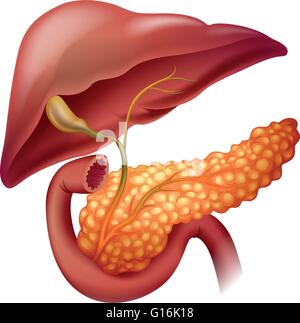 Pancreas cancer diagram in detail illustration Stock Vector