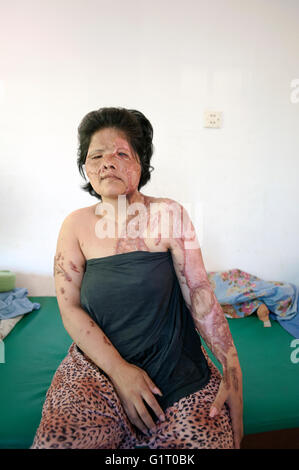 Acid throwing violence survivor Keo Srey Vy at CASC (Cambodian Acid Survivors Charity) in  Phnom Penh in Cambodia. Stock Photo