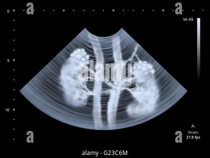 Ultrasound scan of human kidneys. Illustration Stock Photo