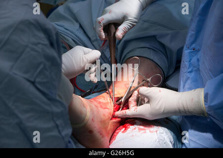 Open reduction and internal fixation of ankle Stock Photo