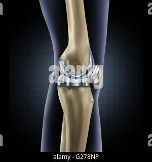 Knee replacement implant medical concept as a human leg anatomy after a prosthetic surgery as a musculoskeletal disease treatment symbol for orthopedics with 3D illustration elements. Stock Photo
