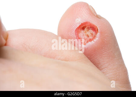 The wound medicine, after removal of corn laser Stock Photo