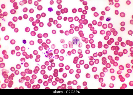 Photomicrograph of human white blood cells with acute myelocytic ...