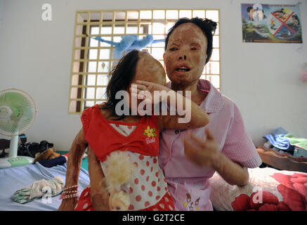 Cambodian acid violence survivors Chheav Chenda and her daughter Bun Cheata at Cambodian Acid Survivors Charity (CASC). Stock Photo